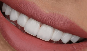 کامپوزیت دندان جلو یا باندینگ دندان جلو چیست