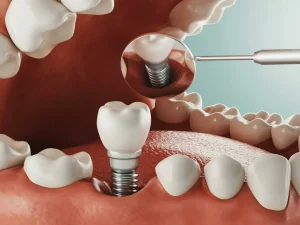 ایمپلنت دندان: از نوع دیجیتالی تا ایمپلنت یک روزه