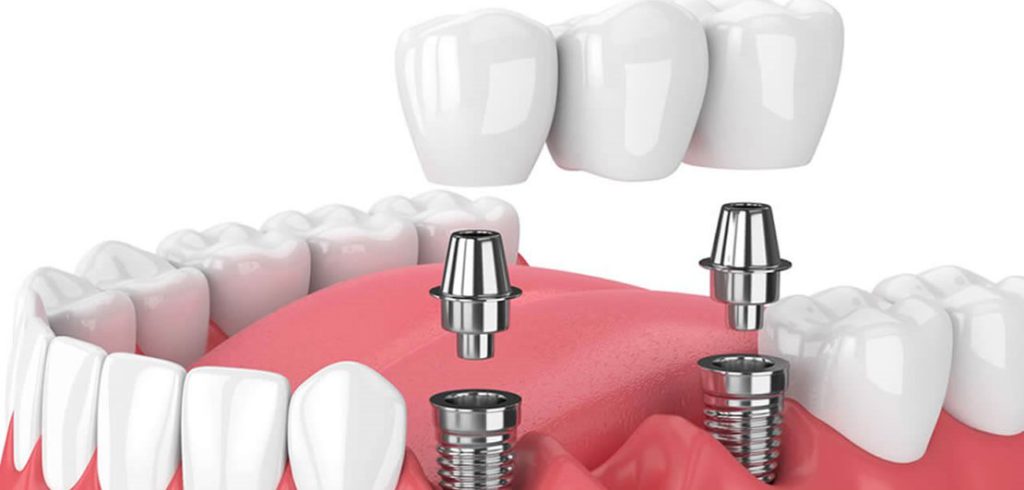 با انواع ایمپلنت دندان بیشتر آشنا شوید.