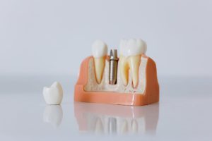 ایمپلنت SNUC + بهترین برند کره‌ای ایمپلنت دندان