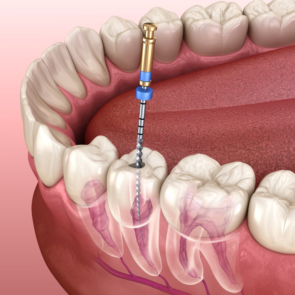 عصب‌کشی دندان چگونه انجام می‌شود؟ | مراحل عصب کشی دندان | روت کانال